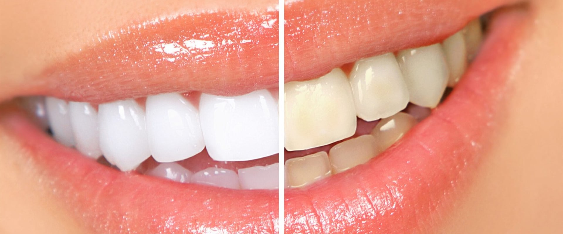 The Pros and Cons of Teeth Whitening What You Need to Know