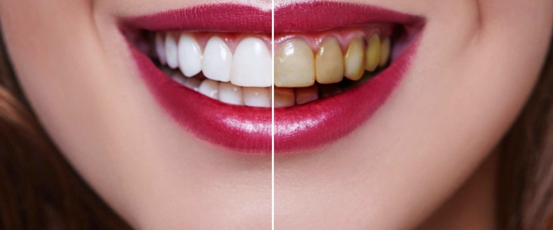How Long Does Professional Teeth Whitening Take to Work?