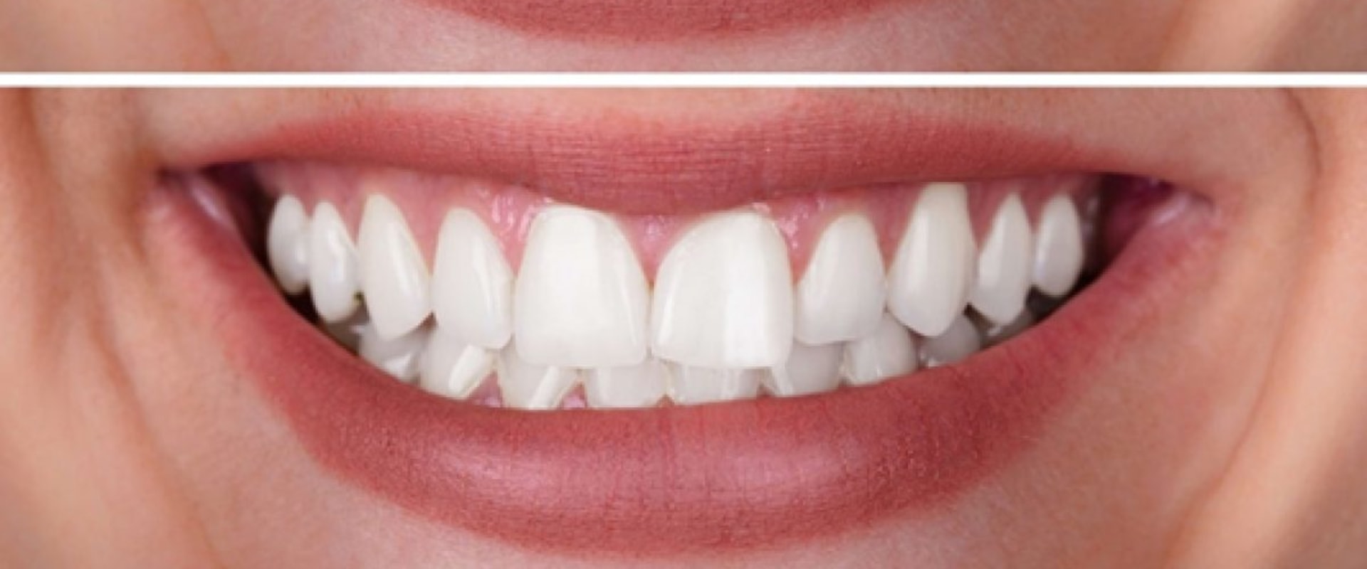 Combining Different Methods of Tooth Bleaching