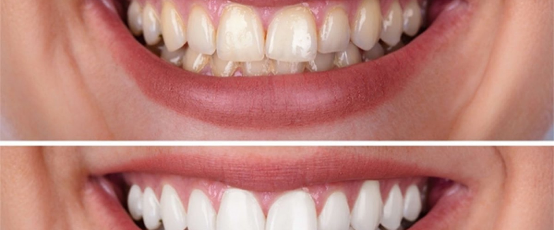The Pros and Cons of Teeth Whitening