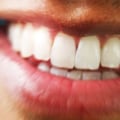 Can I Get My Dentist to Do a Home-Based Teeth Whitening Treatment?