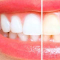 How to Whiten Teeth at Home: Expert Tips and Tricks