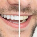 Can Laser Teeth Whitening Damage Your Teeth?