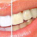 The Most Reliable and Effective Teeth Whitening Treatment