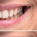 The Best Over the Counter Teeth Whitening Solutions