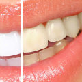 Safely Whitening Your Teeth: What You Need to Know