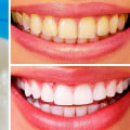 The Most Effective Ways to Whiten Teeth at Home
