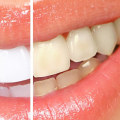 The Pros and Cons of Teeth Whitening: What You Need to Know