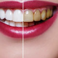 Does Teeth Whitening Cause Long-Term Damage?