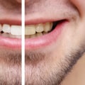 Is Teeth Whitening Safe? Expert Advice on How to Whiten Your Teeth Safely