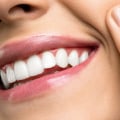 Everything You Need to Know About Teeth Whitening