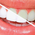 Does Professional Teeth Whitening Work Better Than At Home?