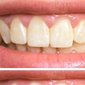What is Teeth Whitening and How Does it Work?
