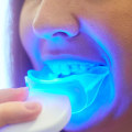 Is DIY Teeth Whitening Safe? Expert Advice on Home Whitening
