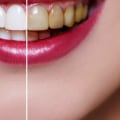 Are There Any Long-Term Effects of Professional Teeth Whitening Treatments?