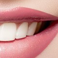 The Benefits of Teeth Whitening: A Professional's Perspective