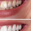 The Pros and Cons of Teeth Whitening