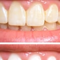 Can You Get Your Teeth Professionally Whitened More Than Once?