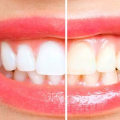 Combining Different Methods of Tooth Whitening