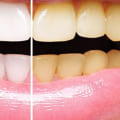 How Does Teeth Whitening Work? A Comprehensive Guide