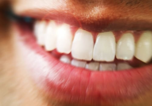Can I Get My Dentist to Do a Home-Based Teeth Whitening Treatment?