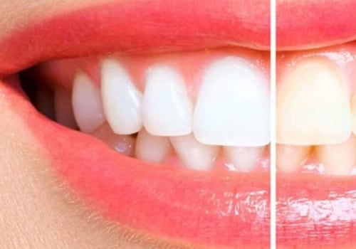 How to Whiten Teeth at Home: Expert Tips and Tricks