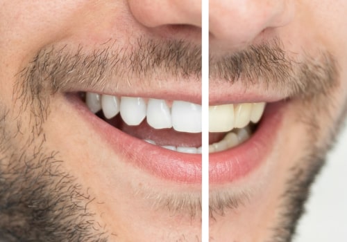 Can Laser Teeth Whitening Damage Your Teeth?