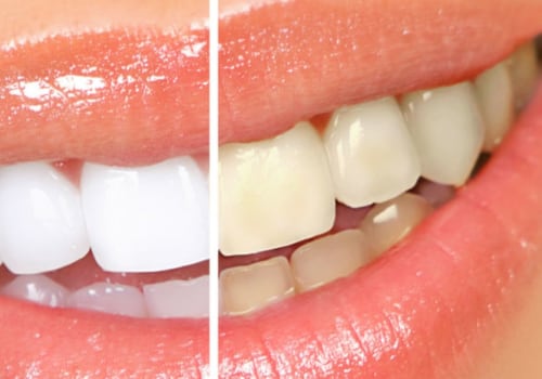 The Most Reliable and Effective Teeth Whitening Treatment