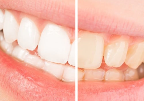 Can You Drink Coffee and Wine After Teeth Whitening?