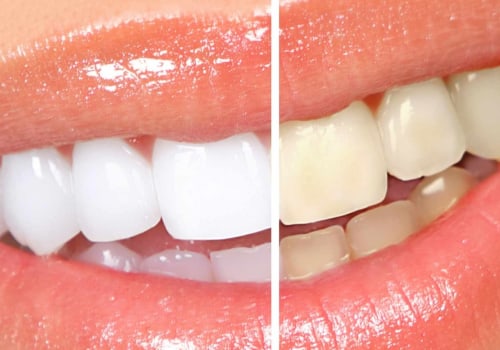 Safely Whitening Your Teeth: What You Need to Know