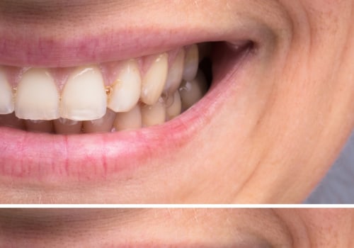 The Pros and Cons of Over-the-Counter Teeth Whitening Products