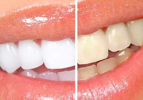 The Pros and Cons of Teeth Whitening: What You Need to Know