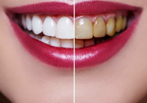 Does Teeth Whitening Cause Long-Term Damage?