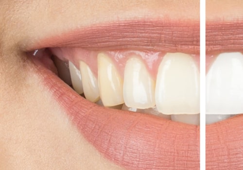 7 Tips for Teeth Whitening: Expert Advice from Dentists
