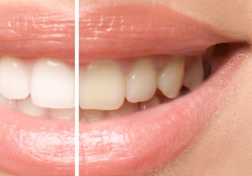 Maintaining White and Healthy Teeth: A Guide for a Bright Smile