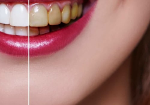 How Often Should You Whiten Your Teeth?