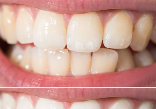 Can You Get Professional Teeth Whitening at Home?
