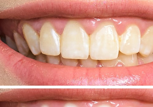 What is Teeth Whitening and How Does it Work?