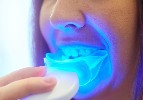 Is DIY Teeth Whitening Safe? Expert Advice on Home Whitening