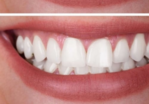 Combining Different Methods of Tooth Bleaching