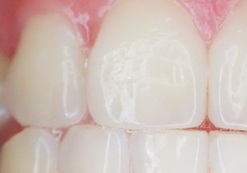 Are There Any Risks of Using Over-the-Counter Teeth Whitening Products?