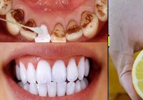 Can Lemon Juice Really Whiten Your Teeth?