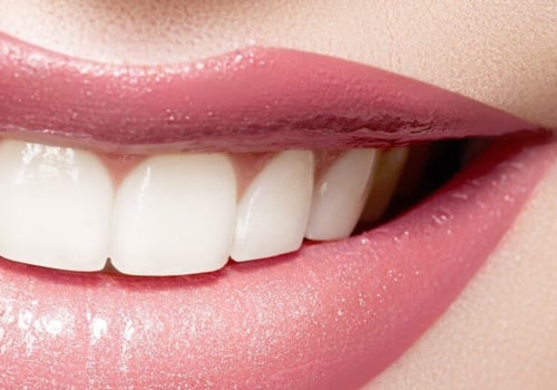 The Benefits of Teeth Whitening: A Professional's Perspective