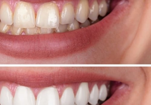 The Pros and Cons of Teeth Whitening