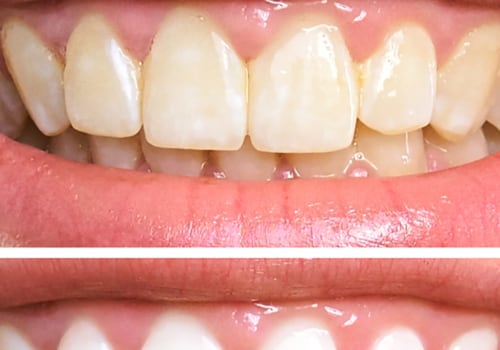 Can You Get Your Teeth Professionally Whitened More Than Once?