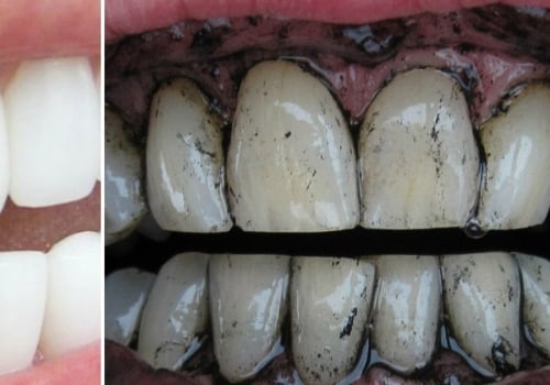 Can Charcoal Whiten Your Teeth? An Expert's Guide