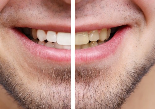 Is Teeth Whitening Safe and Effective?