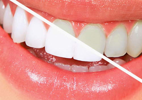The Best Teeth Whitening Products: A Comprehensive Guide