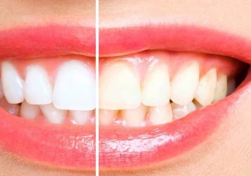 Combining Different Methods of Tooth Whitening