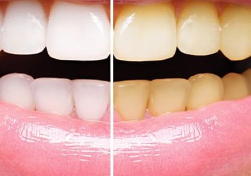 How Does Teeth Whitening Work? A Comprehensive Guide